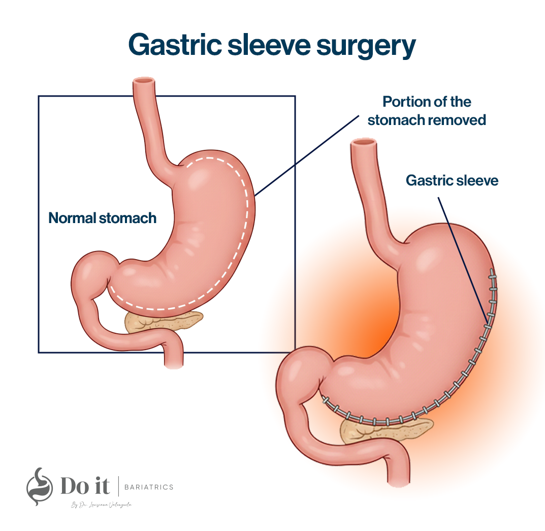 Gastric Sleeve